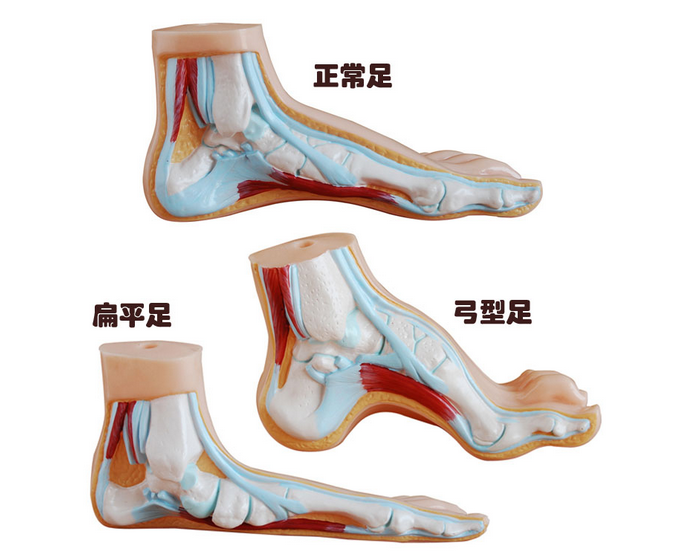 正常足、扁平足、弓型足模型